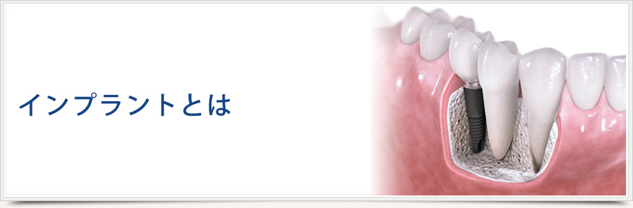 インプラントとは