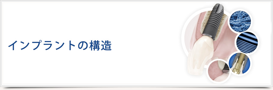 インプラントの構造