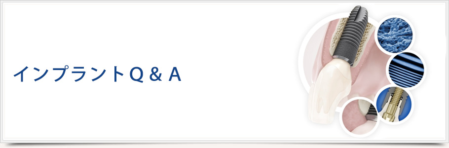 インプラントQ&A