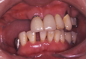 インプラント症例１－治療前