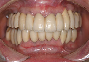 インプラント症例1-治療後