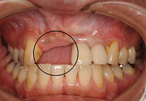インプラント症例2-治療前