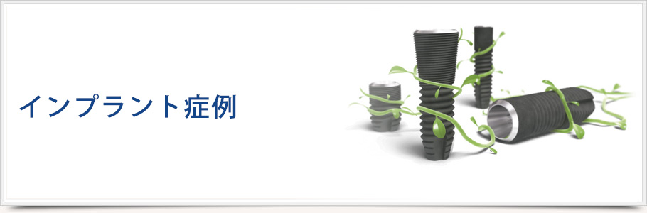 インプラント1回法と2回法